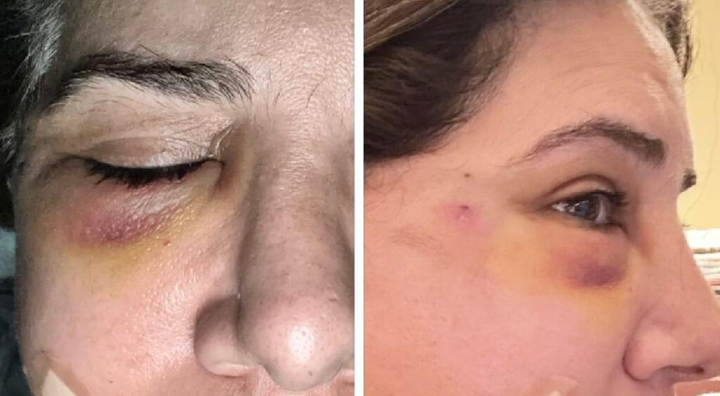 Pakistani Jasmeen Manzoor Shares Photos of Brutal Assault