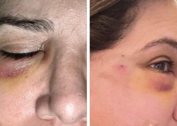 Pakistani Jasmeen Manzoor Shares Photos of Brutal Assault