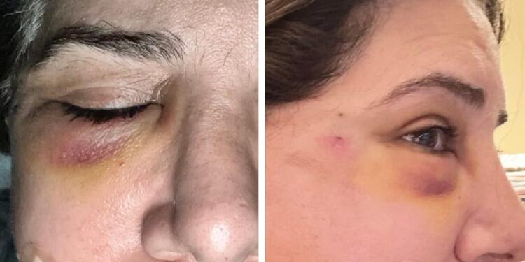 Pakistani Jasmeen Manzoor Shares Photos of Brutal Assault