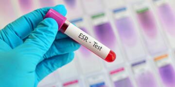 Erythrocyte Sedimentation Rate (ESR) Test: Meaning, Normal Range & Uses