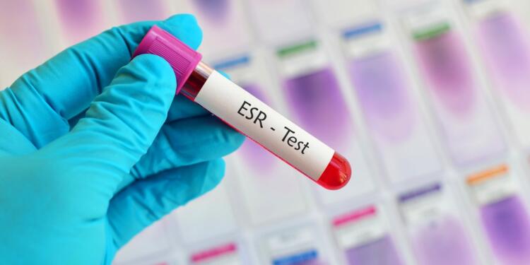Erythrocyte Sedimentation Rate (ESR) Test: Meaning, Normal Range & Uses