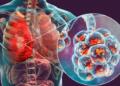 Centre Unveils AI-Led Precision Strategy to Eliminate TB, Zeroes In on Delhi’s 38 High-Burden Wards