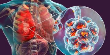 Centre Unveils AI-Led Precision Strategy to Eliminate TB, Zeroes In on Delhi’s 38 High-Burden Wards